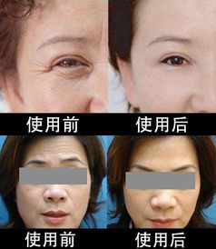 霧化多肽微雕注意事項(xiàng)