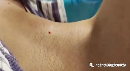 消融術(shù)后飲食注意事項(xiàng)