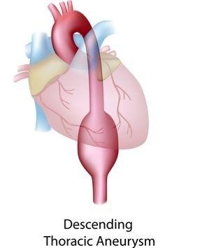 動(dòng)脈瘤支架植入術(shù)后康復(fù)注意事項(xiàng)