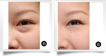 眼部抽脂術后注意事項