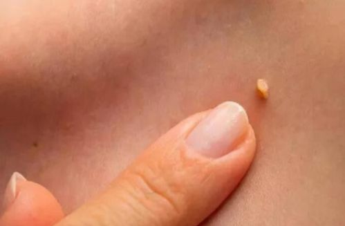 皮肌炎恢復(fù)期要注意事項(xiàng),皮肌炎的注意事項(xiàng),皮肌炎日常注意事項(xiàng)