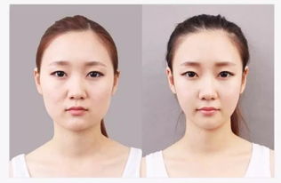 面部抽脂術(shù)后注意事項,抽脂手術(shù)前后注意事項,面部刷酸前后注意事項