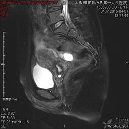 mri增強檢查注意事項