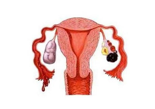 巧克力囊腫術后飲食注意事項