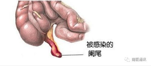 闌尾炎,切除,注意事項(xiàng),飲食