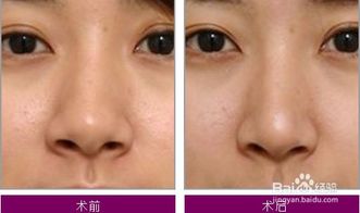 整容,術(shù)前,注意事項(xiàng)