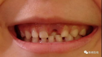 注意事項,拔多生牙前