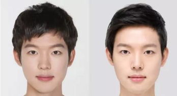 長春短鼻矯正術(shù)的相關(guān)注意事項