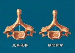 脊椎,狹窄,注意事項(xiàng)