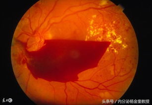 眼底水腫要注意事項