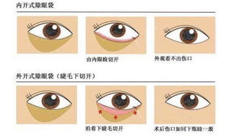 眼袋在家注意事項(xiàng)