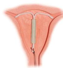 取宮內節(jié)育器注意事項