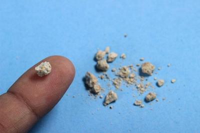 尿道結(jié)石飲食應(yīng)該注意什么,尿道結(jié)石術(shù)后飲食注意事項(xiàng),尿道結(jié)石碎石后飲食注意事項(xiàng)