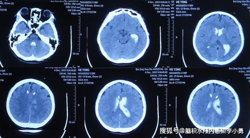 腦引流術(shù)后注意事項