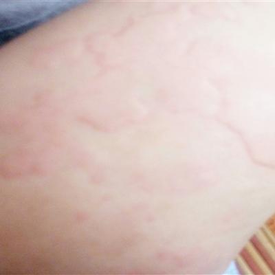 風(fēng)疹,注意事項