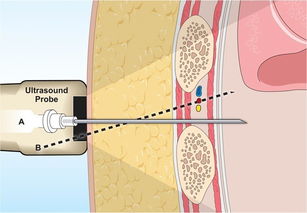 胸腔穿刺的注意事項,胸腔穿刺的適應癥及注意事項,胸腔穿刺步驟及其注意事項