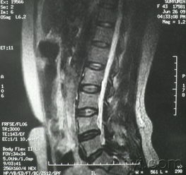 神經(jīng)根受損后注意事項
