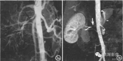 心血管ct注意事項(xiàng)