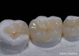 嵌體補(bǔ)牙后注意事項(xiàng),瓷嵌體補(bǔ)牙后注意事項(xiàng),補(bǔ)牙后的注意事項(xiàng)