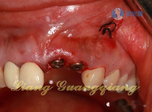 牙植骨后注意事項,牙槽植骨術(shù)后注意事項,種牙植骨拆線后注意事項