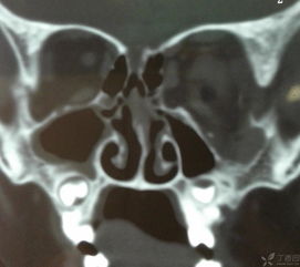 鼻漏修補后注意事項,腦脊液漏注意事項,漏尿注意事項