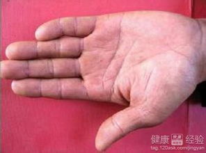 皮下結節(jié)注意事項