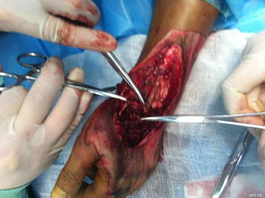 狗腿縫合后注意事項(xiàng)