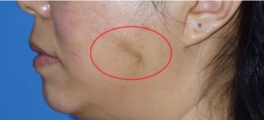 做完,手術(shù)后,脖子,注意事項(xiàng)