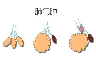 肺氣腫,青海,注意事項(xiàng)