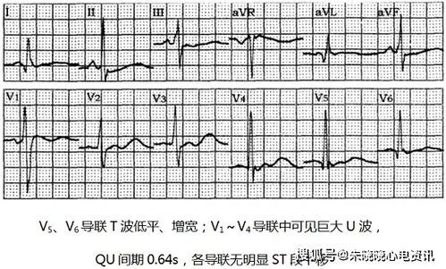 孕婦低鉀血癥注意事項