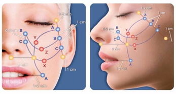 韓國蛋白螺旋線埋入后注意事項