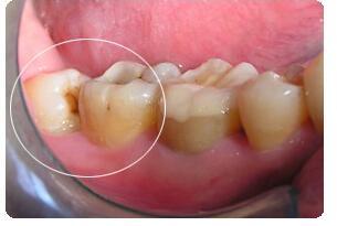 智牙拔掉注意事項