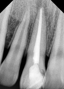 根管治療后樹脂補牙能用多久,根管治療后樹脂補牙步驟,根管治療后樹脂補牙費用