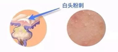 粉刺清理后注意事項(xiàng)