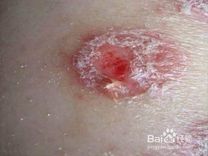 銀屑病治療方案及注意事項(xiàng),銀屑病關(guān)節(jié)炎注意事項(xiàng),銀屑病平時(shí)注意事項(xiàng)