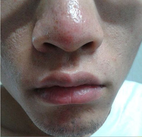 酒糟鼻子的注意事項