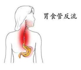 返流胃炎注意事項