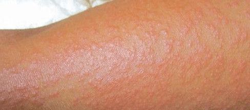 沙土性皮炎注意事項(xiàng),激素性皮炎注意事項(xiàng),藥物性皮炎注意事項(xiàng)