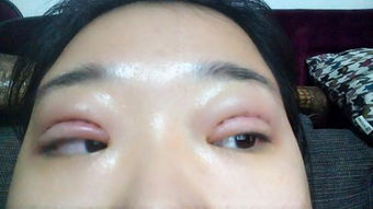 全切雙眼皮術后注意事項,做完全切雙眼皮注意事項有哪些,全切雙眼皮注意事項有哪些