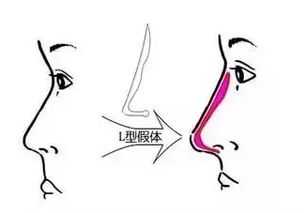 取鼻假體注意事項,取假體術(shù)后注意事項,取下巴假體注意事項