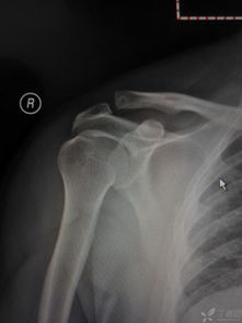 肩鎖關(guān)節(jié)脫位保守治療后遺癥,肩鎖關(guān)節(jié)脫位保守治療能治愈,肩鎖關(guān)節(jié)脫位保守治療恢復(fù)時(shí)間