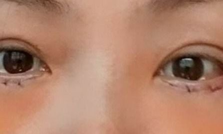 割下眼袋的注意事項(xiàng)