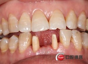 修復,注意事項,全瓷冠