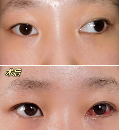 斜視手術(shù)前注意事項(xiàng)