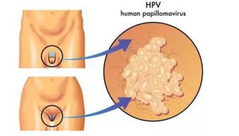 尖銳濕疣,北京,注意事項(xiàng),軍都診