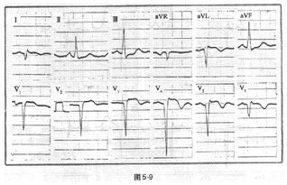注意事項(xiàng),前壁心梗后