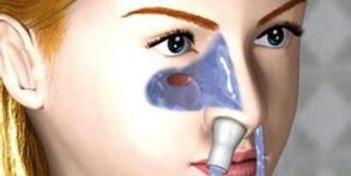 鼻竇炎,清洗,注意事項(xiàng)