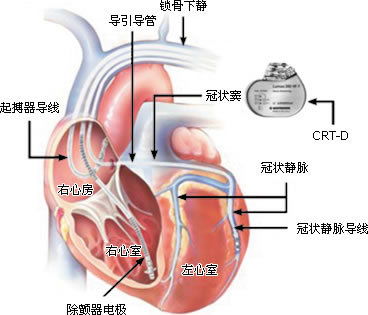 體外起搏器注意事項(xiàng)