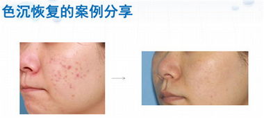 激光術(shù)后應(yīng)該注意些什么,激光手術(shù)后需要注意什么,激光治療后注意事項(xiàng)