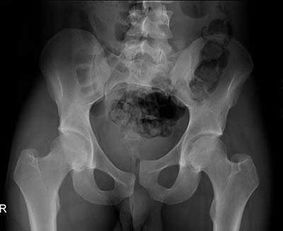 骶椎骨折注意事項(xiàng),骶椎骨折恢復(fù)注意事項(xiàng),女性尾椎骨折注意事項(xiàng)